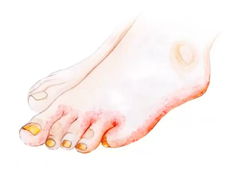 Fungus in the toe and how to apply cream Zenidol