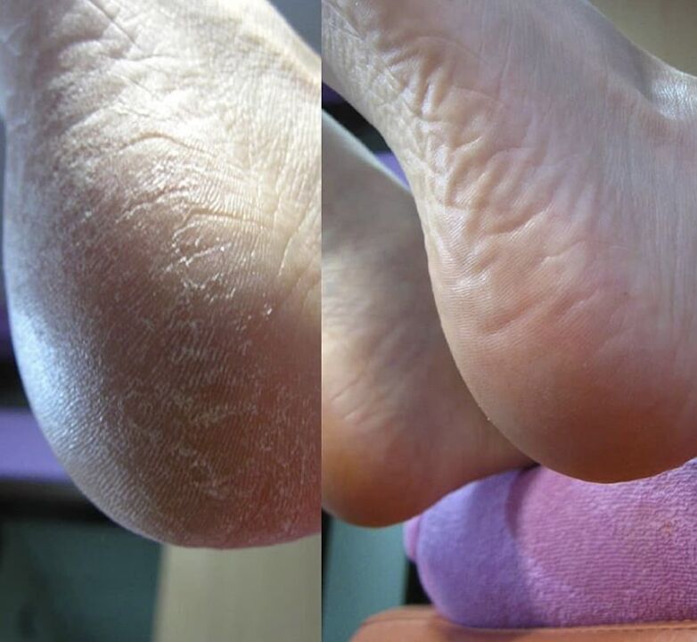 Heel photo before and after using Zenidol cream