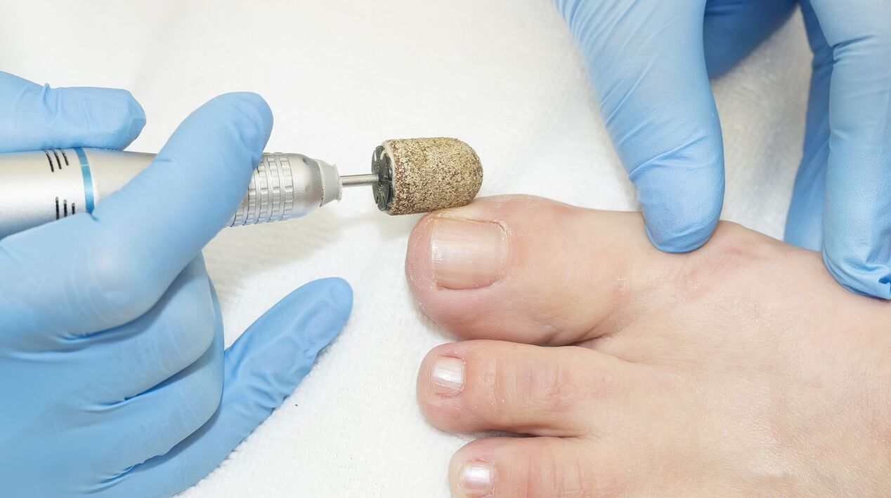 Hard treatment of fungus on toenails