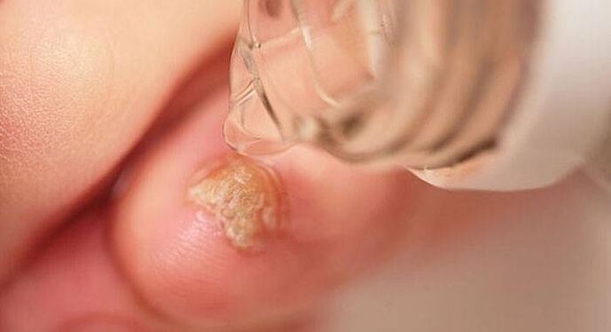 drops from fungus on toenails