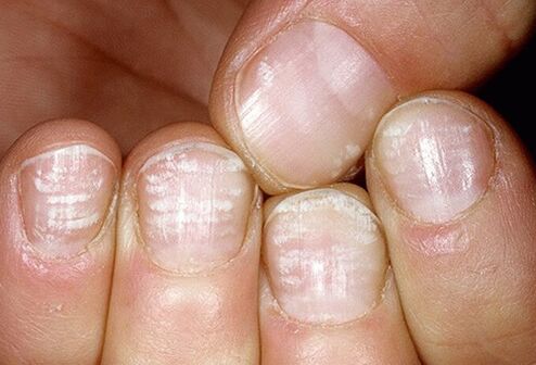 fungal infection in the nail