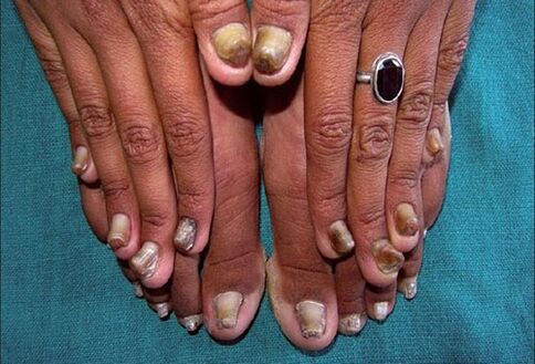 fungus on nails and feet