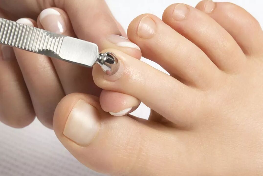 What to use to treat nail fungus 