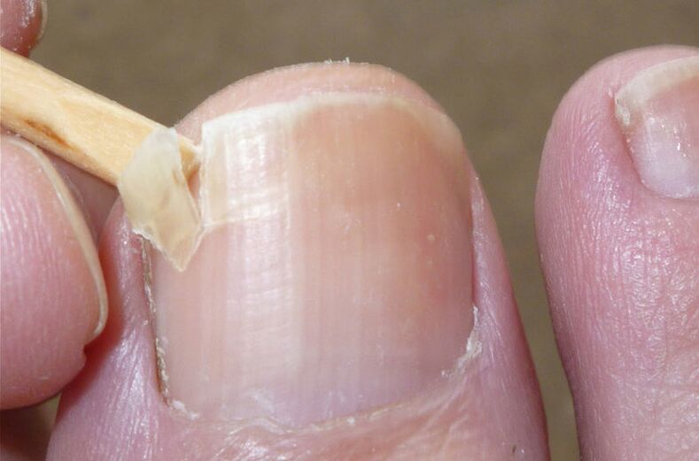 Damaged nails are at risk of fungal infection