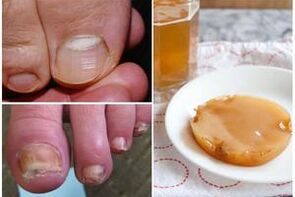 Kombucha is a popular folk remedy for treating nail fungus. 