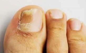 Nails are affected by fungus