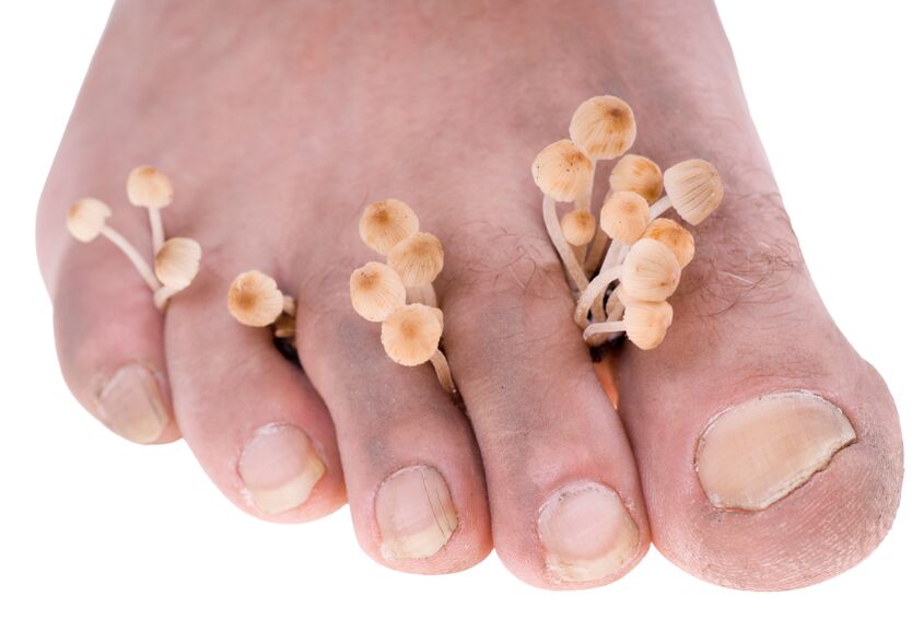 interdigital fungus of the feet
