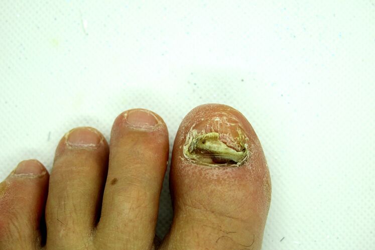 Finger Nail Fungus - Heavy phase