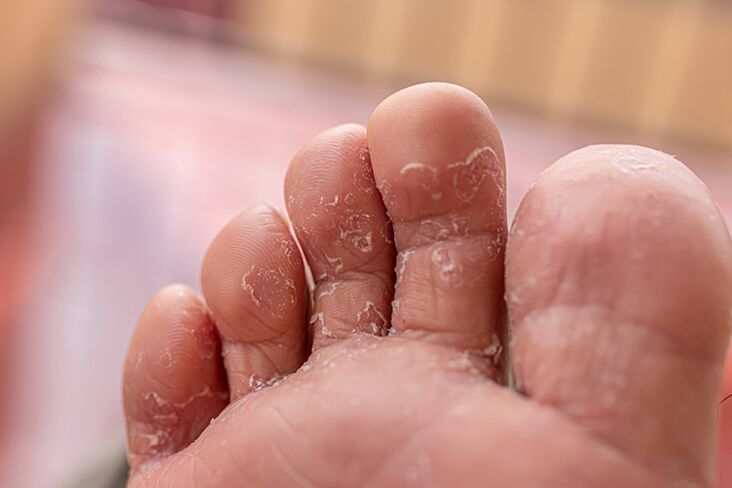 Finger Skin Fungus - Initial period
