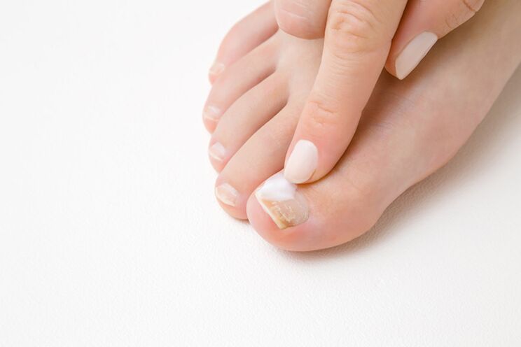 Finger treatment with ointment from mushrooms