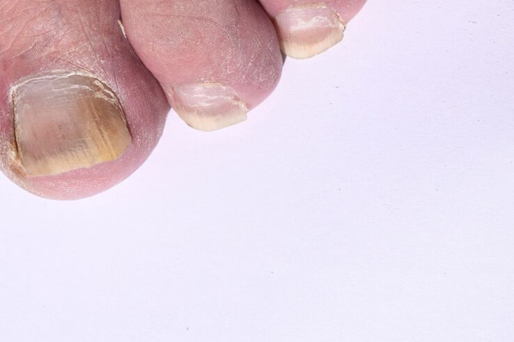 The initial phase of Mycosis of nails on the feet