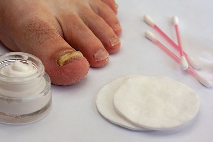 Treatment of finger fungus with mushroom cream