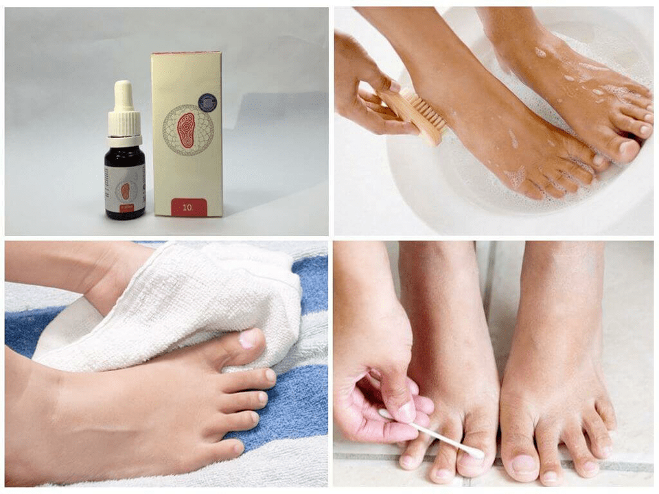 Various remedies for foot fungus