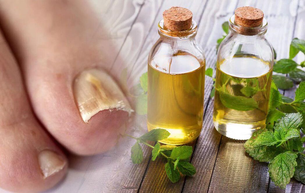 Vinegar treats nail fungus