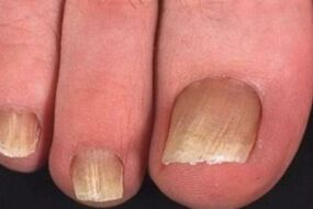 Toenail fungal infection