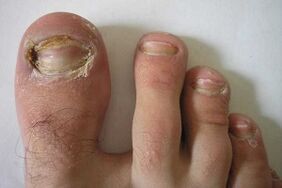 damage to the nail plates of the toes due to fungal infection