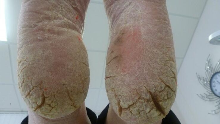 Symptoms of fungus on the feet
