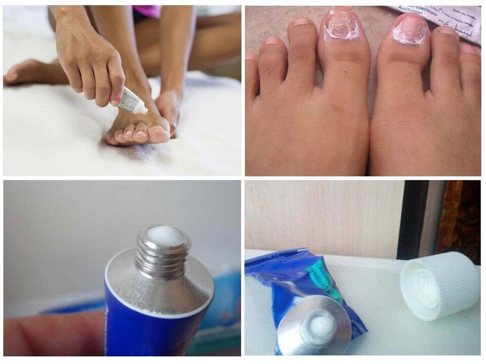 Effective medicine to treat nail fungus