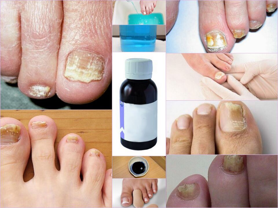 toenail fungus medicine