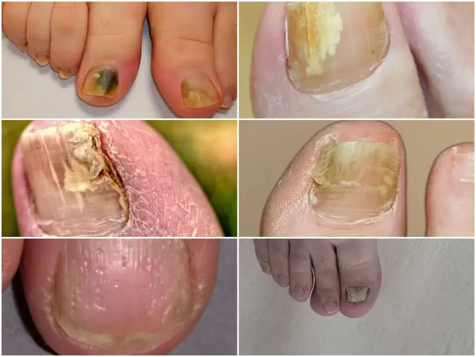 Symptoms of onychomycosis - change in color and structure of the nail