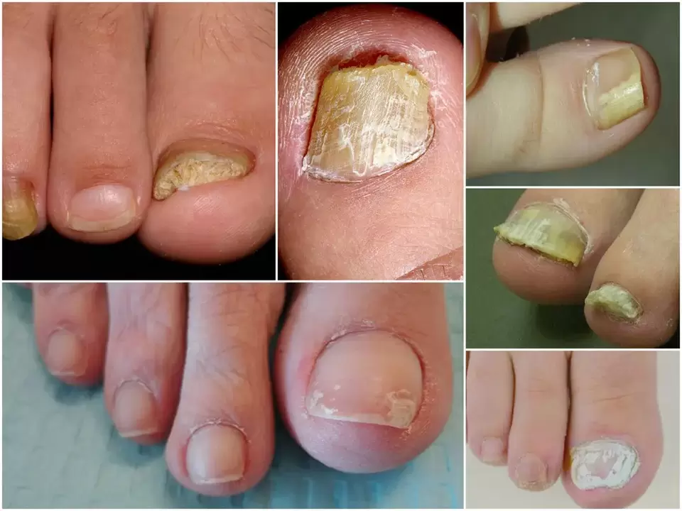 The occurrence of different forms of onychomycosis