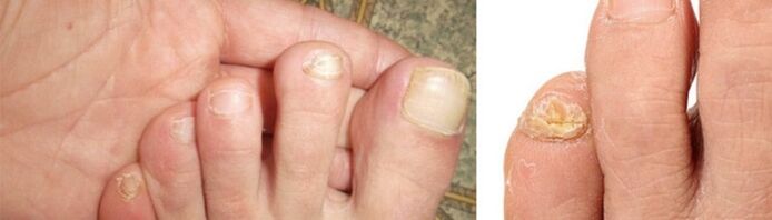 Photo of fungus manifestations on the toenails