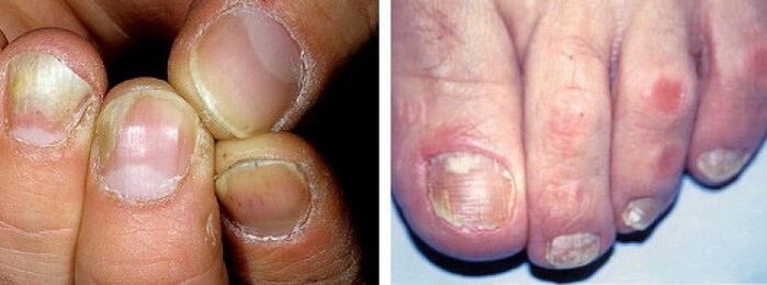 manifestation of a fungal infection on the nail