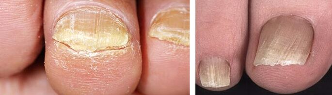 nail damage caused by a fungal infection