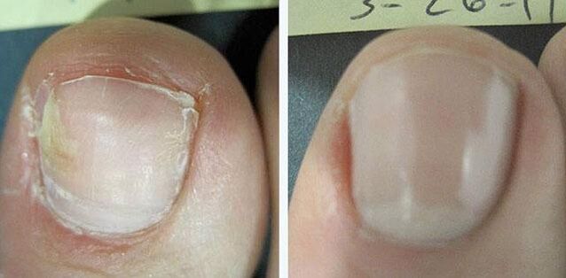 before and after the nail fungus treatment