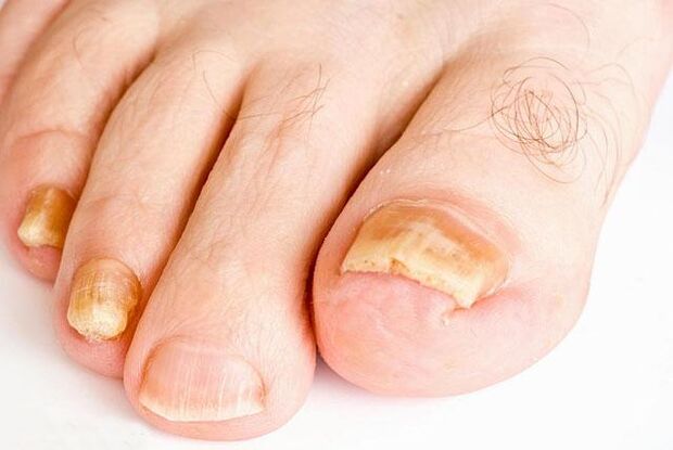 toenail fungus looks like