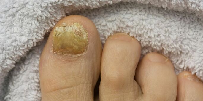 Yellow toenails infected with fungus