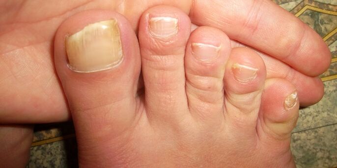 toenail damage with fungus