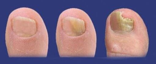 stages of growth of fungus on the toenails