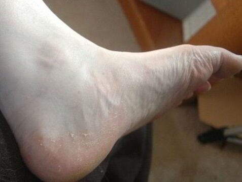 Peeling of the skin of the feet is a sign of a fungal infection. 