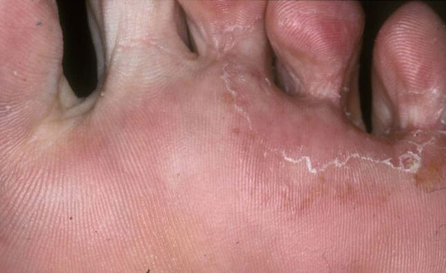 The foot is affected by the trichophyton rubrum fungus
