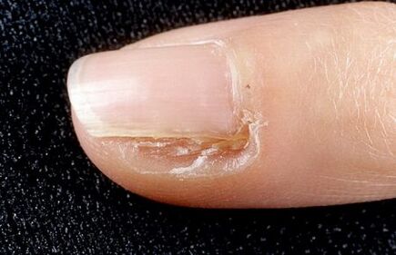 Cut off a part of the nail that has fungus