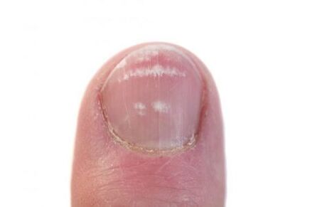 early stages of fungal nail infection